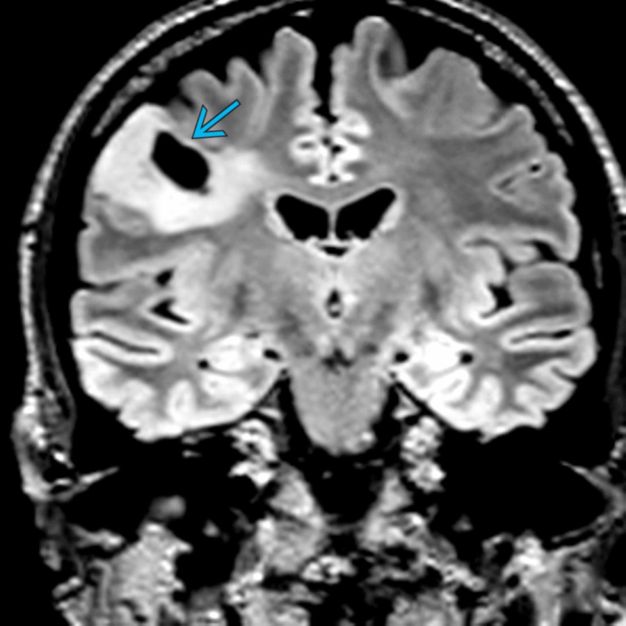 Coronal FLAIR MR shows a cortical hyperintense mass in the posterior frontal lobe with a focal cyst . This was a pleomorphic xanthoastrocytoma at surgery.