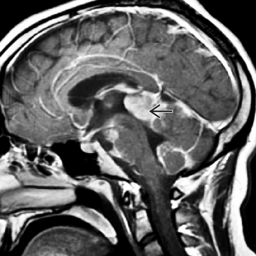 Sagittal T1WI C+ MR shows an enhancing mass in the pineal region  causing mass effect on the tectal plate and aqueductal obstruction. Note the extensive leptomeningeal enhancement due to CSF spread of tumor. CSF cytology showed a primitive neuroectodermal tumor.