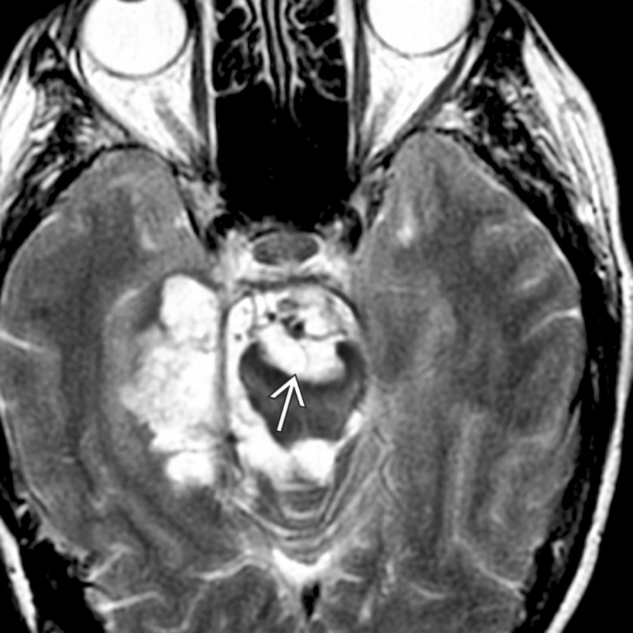 Axial T2WI MR shows an epidermoid cyst in the suprasellar cistern, widening the interpeduncular fossa  and extending into the ambient and quadrigeminal cisterns.