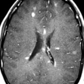 Axial T1WI C+ MR demonstrates nodular, enhancing MS plaques. Note the common periventricular location with perpendicular orientation, as well as the involvement of subcortical WM.