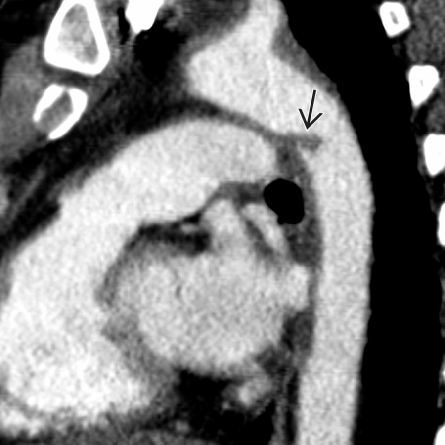 Sagittal CECT in a patient involved in a motor vehicle collision shows a transverse segmental tear at the aortic isthmus  without a surrounding mediastinal hematoma, consistent with MAI. The patient had no additional chest injuries, was treated conservatively, and was followed annually with CT.