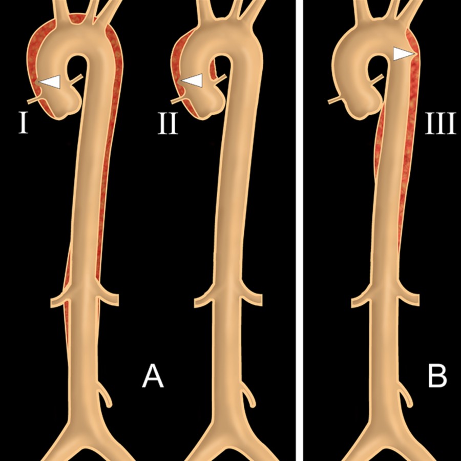 DeBakey type I and Stanford class A include dissections that involve the ascending aorta. DeBakey type II is confined to the ascending aorta, and type I extends beyond. DeBakey type III dissections are confined to the descending aorta. Stanford class B includes all dissections not involving the ascending aorta (involving arch &/or descending aorta).
