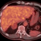 Axial PET/CT in the same patient shows mild uptake in the right adrenal mass , less than that of the adjacent hepatic parenchyma , further supporting the diagnosis of adenoma made on MR.