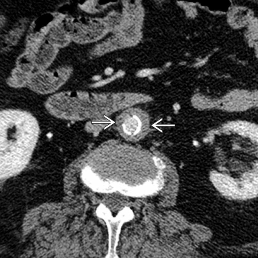 Axial CECT shows a narrowed aorta with circumferential wall thickening . Branch vessel stenoses were also present. This patient was > 40 years of age and was diagnosed with giant cell arteritis.