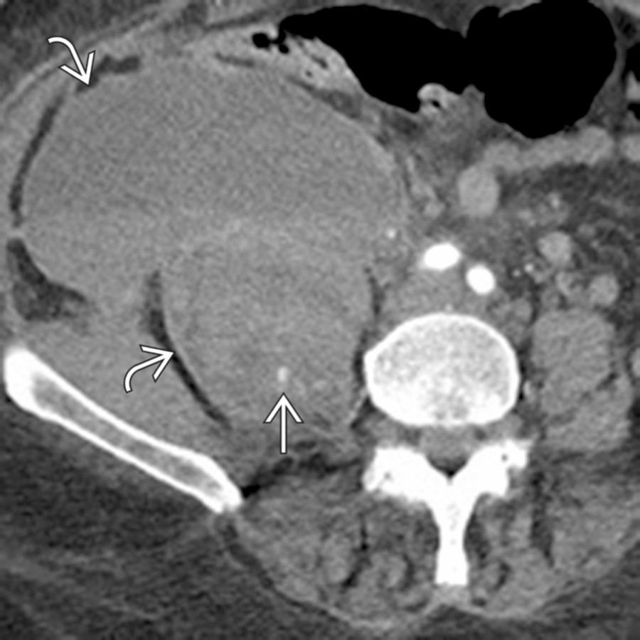Axial CECT shows a large hematoma  extending from the psoas muscle into the adjacent right abdomen. Note the presence of a tiny focus of active extravasation  within the hematoma.