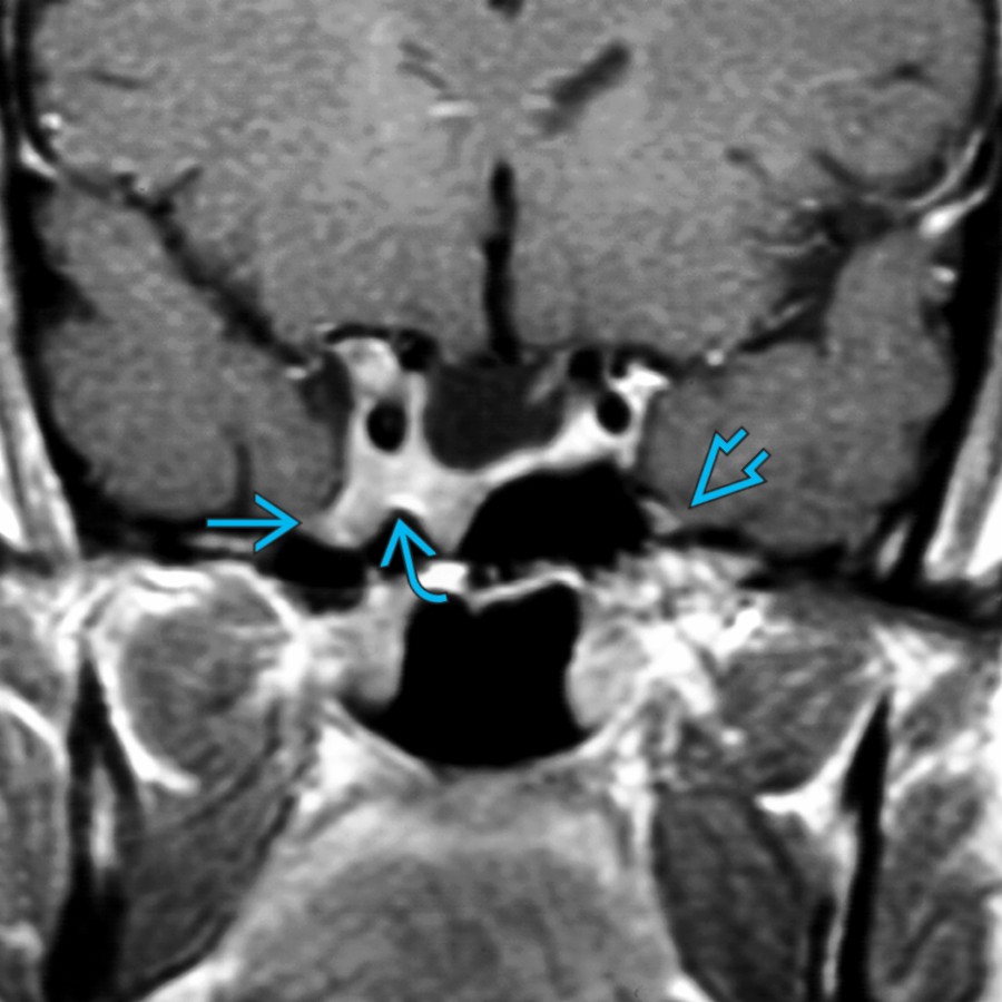 Coronal T1 C+ MR shows a mass in the right cavernous sinus  extending into the foramen rotundum  in a patient with ovarian cancer and right facial numbness. Compare to the normal left side .