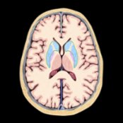 Axial graphic demonstrates brain anatomy and expected area of uptake (blue) in the head of the caudate  and putamen .
