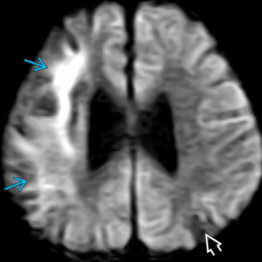 Axial DWI MR in the same patient with moyamoya-type vasculopathy shows diffusion restriction in the right frontoparietal foci of signal abnormality , suggesting an acute/subacute infarct. However, there is no diffusion restriction in the left parietal region , suggesting this infarct is of an older age.