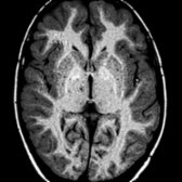 Axial T1WI MR in the same patient at 9 years old shows the "eye" as mostly hyperintense. The appearance of the "eye" in eye of the tiger is variable depending on the stage of the disease. Progressive iron deposition within the globus pallidus likely accounts for greater T1 shortening seen in later disease.