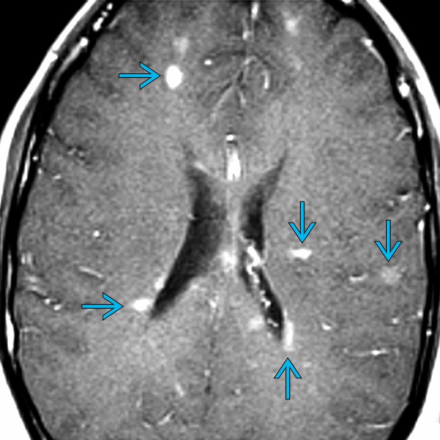 Axial T1 C+ MR demonstrates multiple nodular, enhancing multiple sclerosis plaques . Note the common periventricular location with perpendicular orientation as well as the involvement of subcortical white matter.