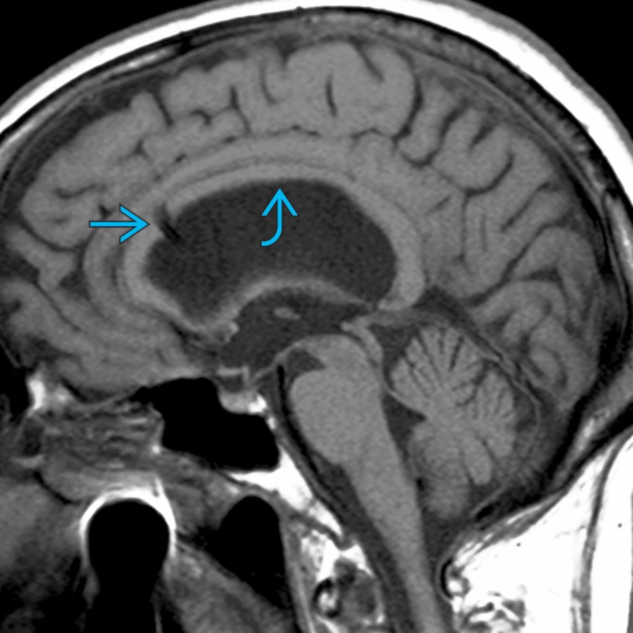 Sagittal T1 MR in a patient with longstanding severe obstructive hydrocephalus demonstrates markedly dilated lateral ventricle with upward displacement and thinning of the corpus callosum (CC)  . Note the shunt catheter , which was placed immediately before the scan.