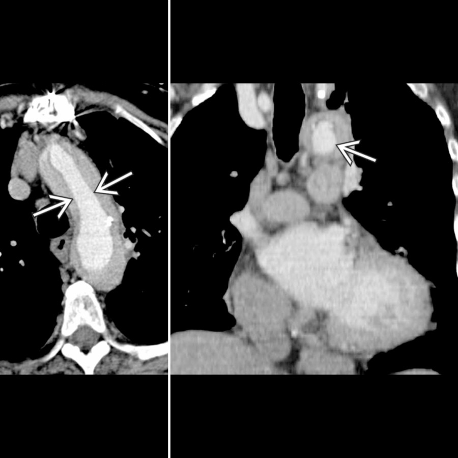 Axial (left) and coronal (right) CTA show atypical appearance of an aortic dissection involving the entire intima  of the thoracic aorta circumferentially. This phenomenon may subsequently lead to intimointimal intussusception.