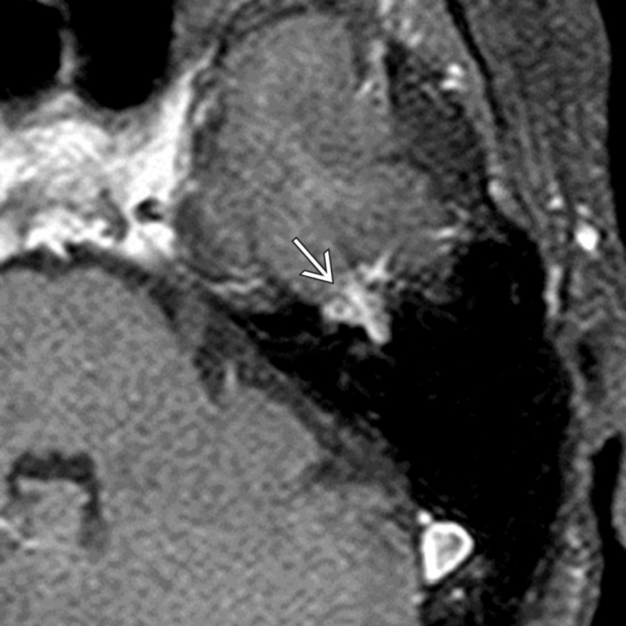 Axial T1 C+ MR with fat saturation in a patient with left atypical Bell palsy reveals a classic left geniculate fossa enhancing FNVM . Punctate areas of high density on bone CT (not shown) confirmed this imaging impression.