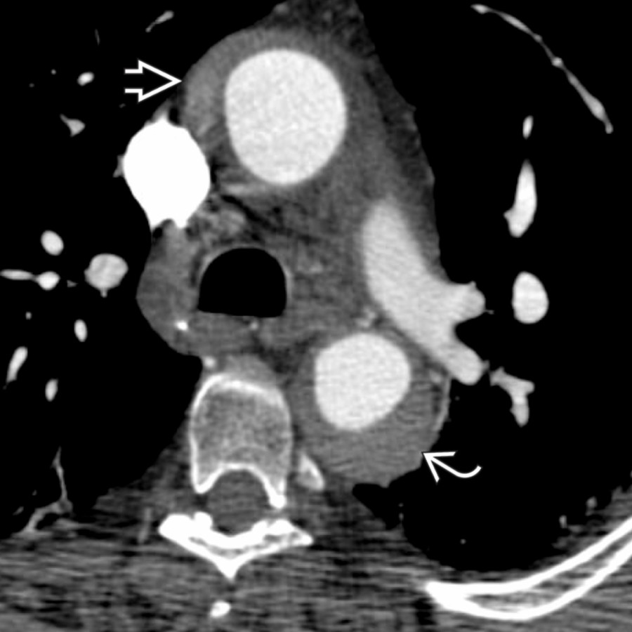 Axial CT angiography shows crescentic aortic wall thickening in the ascending    and descending  aorta. Type A IMH is typically treated surgically.