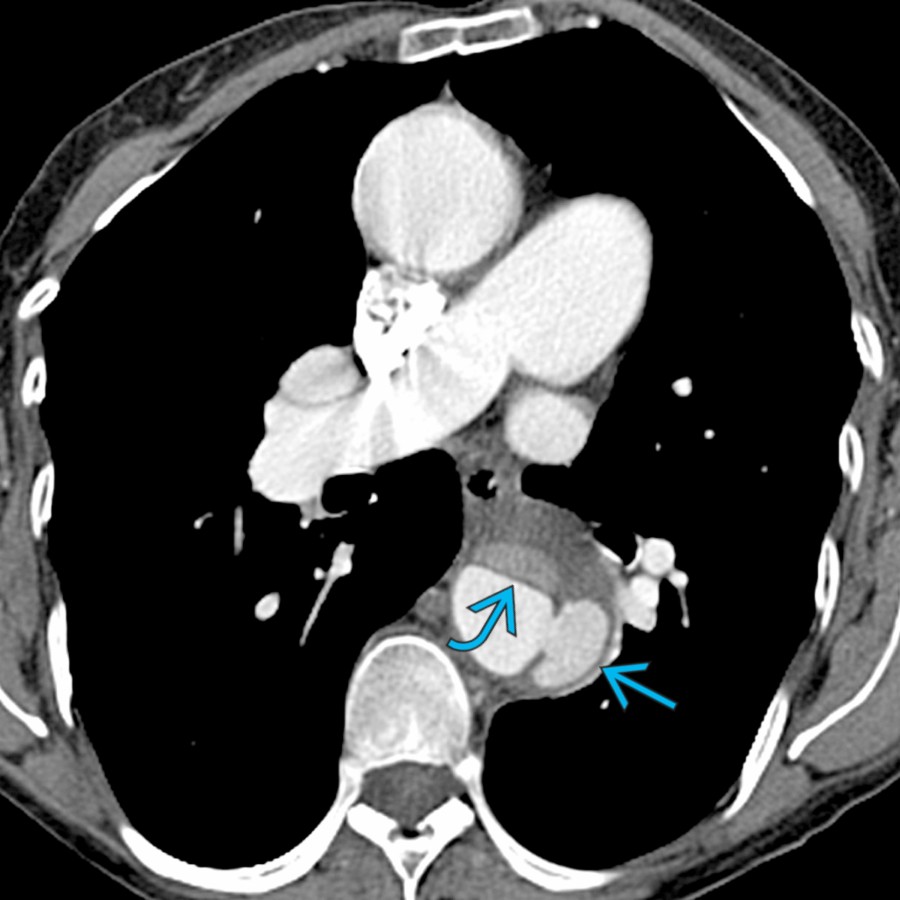 Axial CECT in the same patient shows interval enlargement of ULP  and new aortic dissection . ULP are characterized by absence on baseline, development on follow-up imaging, and wide communication with the aortic lumen. ULP implies a poorer prognosis with evolution into aortic dissection or aneurysm.