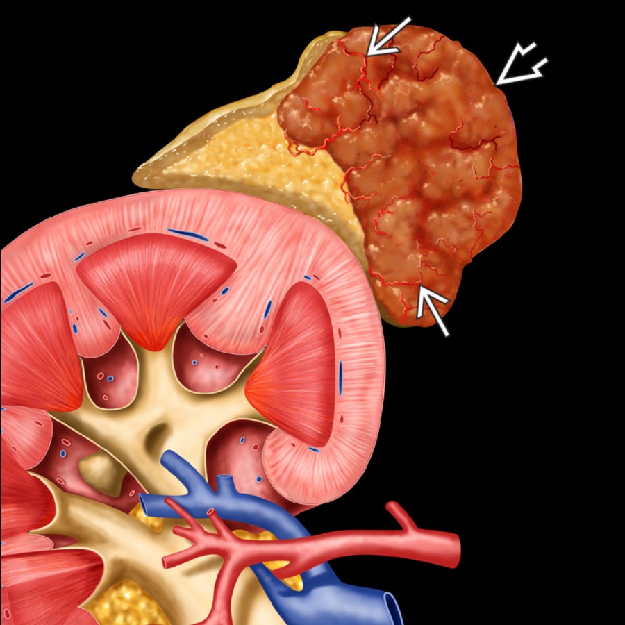 Graphic shows a typical pheochromocytoma , moderate in size with a well-circumscribed margin and solid appearance. Note hypervascularity  of the mass, which commonly results in necrosis and cystic change.