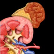 Graphic shows a typical pheochromocytoma , moderate in size with a well-circumscribed margin and solid appearance. Note hypervascularity  of the mass, which commonly results in necrosis and cystic change.