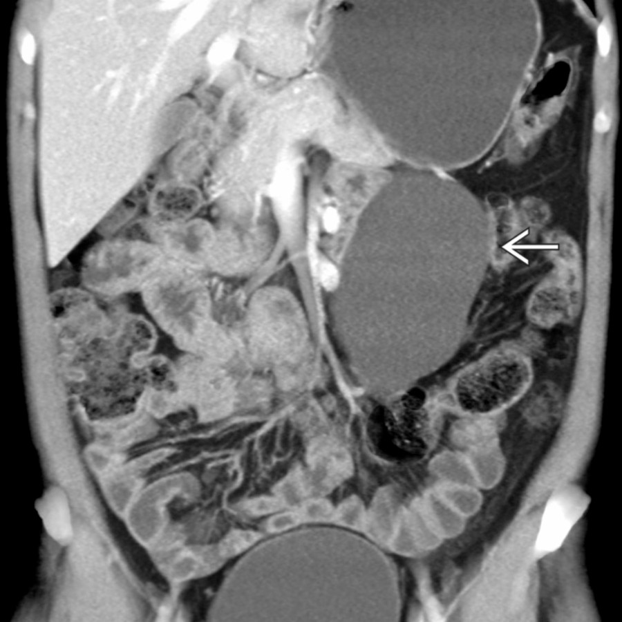 Coronal volume-rendered CECT  demonstrates a large, simple-appearing lymphangioma  in the left hemiabdomen abutting adjacent loops of small bowel without any appreciable internal complexity or enhancement.