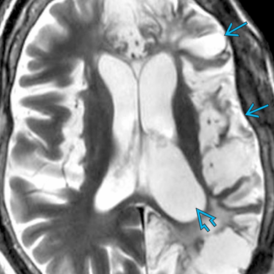 Axial T2WI MR demonstrates generalized left hemispheric encephalomalacia  following necrotizing encephalitis of unknown origin. There is resultant mild ex-vacuo dilatation of the left lateral ventricle .