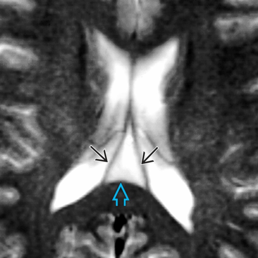 Axial T2 MR shows a small, triangular-shaped CSF space. Note the cavum velum interpositum  interposed between the fornices  and lateral ventricles. The CVI ends at the foramen of Monro.
