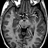 Axial T1WI MR in a patient with PKAN shows hyperintensity of the substantia nigra . The T1 appearance of the globus pallidi and substantia nigra in PKAN is variable.
