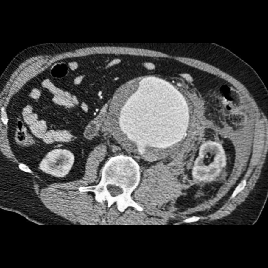 Axial CECT shows a large abdominal aortic aneurysm that has ruptured into the psoas compartment and retroperitoneum. Blood dissects along the left psoas and throughout the retroperitoneal planes.