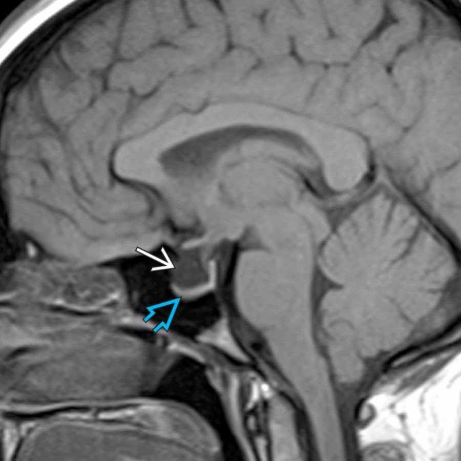 Sagittal T1WI MR shows empty sella with herniation of CSF through the diaphragma sellae , flattening the pituitary gland inferiorly against the sellar floor . Empty sella may be asymptomatic or may be associated with idiopathic intracranial hypertension.