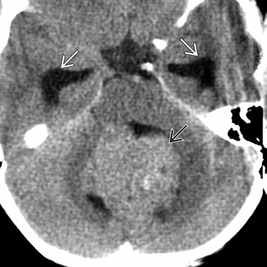 Axial NECT in the same patient shows the large intraventricular mass  within the 4th ventricle. Note the dilated temporal horns .