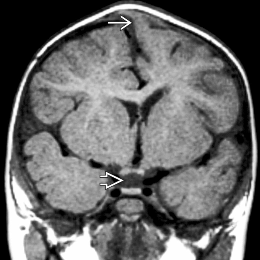 Coronal T1 MR in a child with remote head trauma who subsequently developed pituitary insufficiency shows traumatic cephalocele  and absent/inapparent pituitary stalk .