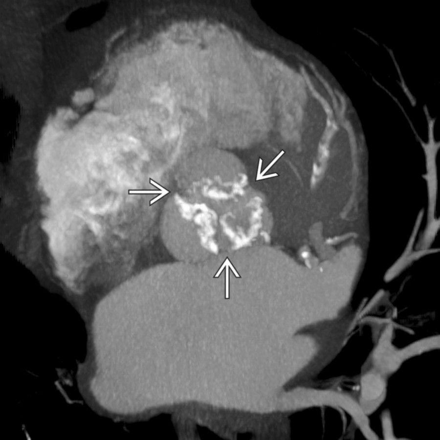 Double oblique CECT MIP shows dense calcifications of the aortic valve cusps  in a patient with severe aortic stenosis. Calcium burden correlates with severity of stenosis.