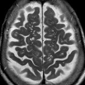 Axial T2 MR in a 84-year-old woman demonstrates numerous enlarged perivascular spaces in the centrum semiovale bilaterally . Note prominence of the cortical sulci due to age-related volume loss. Enlarged perivascular spaces are commonly seen in the midbrain, hippocampi, basal ganglia, & centrum semiovale.