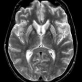 Axial T2WI MR shows bilateral increased signal intensity in putamen and caudate nuclei in a patient with CJD.