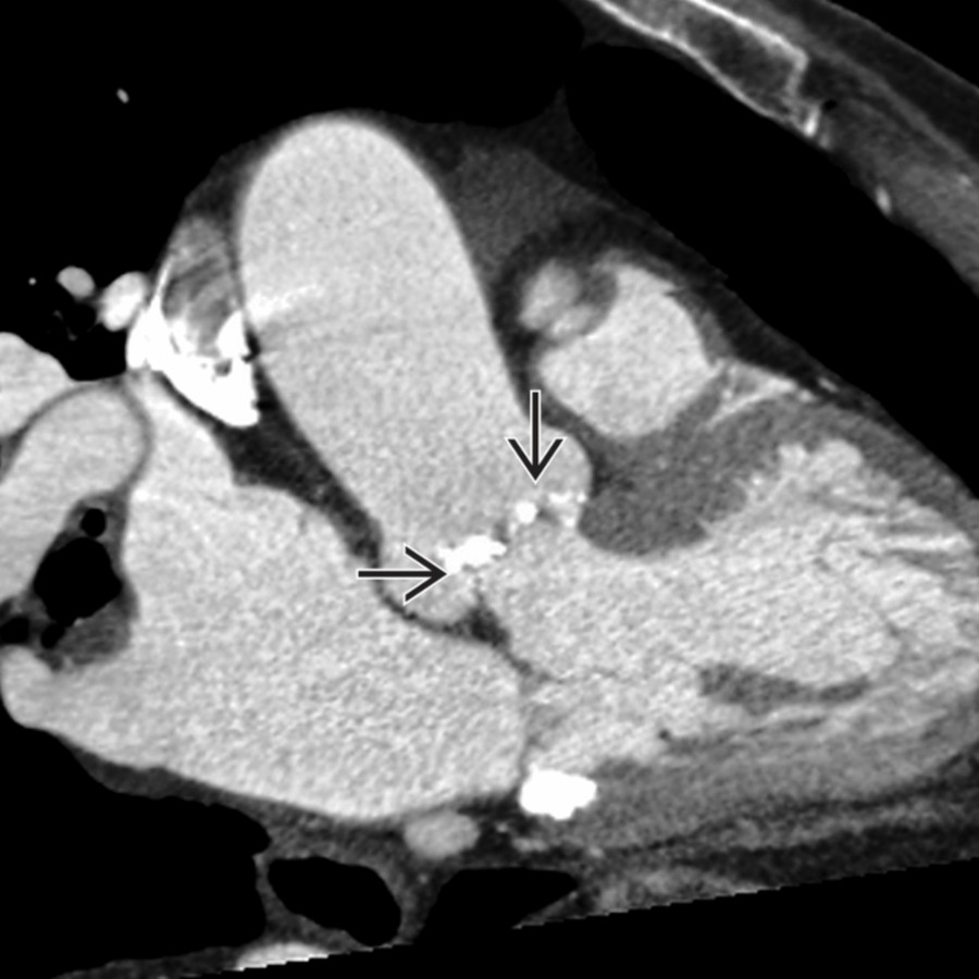 Left ventricular outflow CECT shows calcifications on the aortic cusps  in an older patient with an ascending aortic aneurysm.