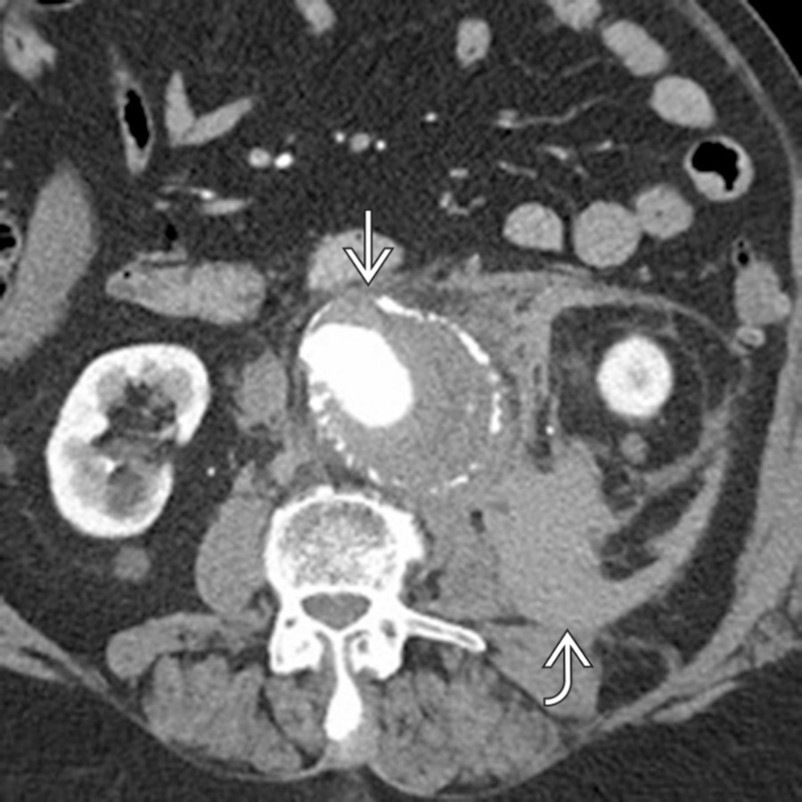 Axial CECT shows a large abdominal aortic aneurysm  with extensive free hematoma  tracking laterally in the retroperitoneum, including immediately adjacent to the psoas muscle, compatible with aneurysm rupture.