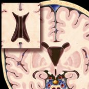 Coronal graphic with axial insert shows classic cavum septi pellucidi (CSP) with cavum vergae (CV) . Note the finger-like CSF collection between the lateral ventricles.