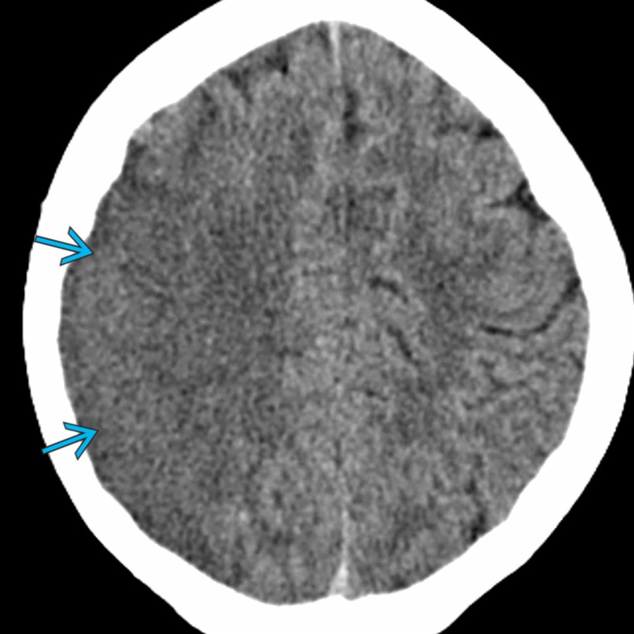Axial NECT in a 15-year-old girl with dilated cardiomyopathy shows a large area of low attenuation in the right MCA territory . Note the sulcal effacement & loss of the gray matter-white matter differentiation.