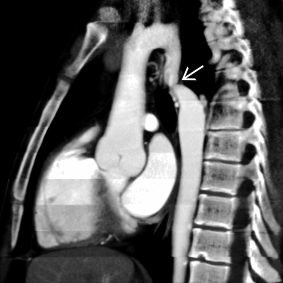 Sagittal multiplanar CT reformat in the same patient shows focal narrowing of the aorta distal to the ductus arteriosus . Prominent collaterals were present (not shown).