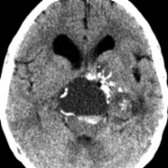 Axial NECT shows classic findings of an adamantinomatous craniopharyngioma. Note the large suprasellar cyst with a fluid-fluid level , rim , and globular   Ca⁺⁺. Enhancement was present on postcontrast images.