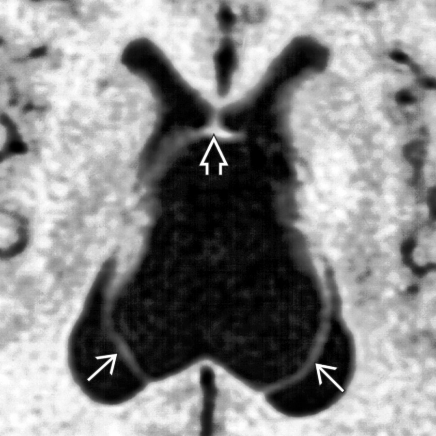 Axial T1 MR shows a very large cavum velum interpositum. Note the splaying of fornices  and anterior displacement of the septum pellucidum . Mild enlargement of the lateral ventricles is seen.