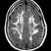 Axial FLAIR MR in the same patient demonstrates prominent subcortical white matter hyperintensity .
