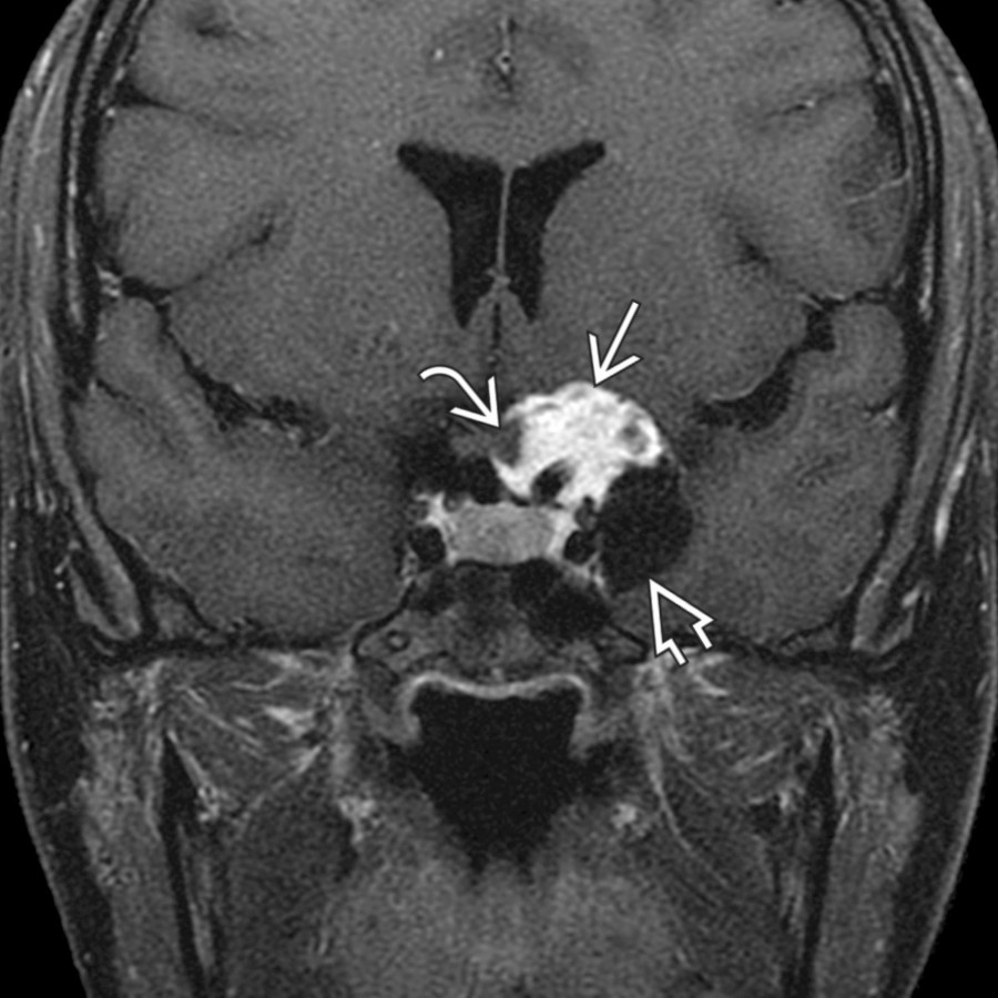 Coronal T1 C+ FS MR in 25-year-old woman with visual complaints shows an enhancing suprasellar mass  that  partially encases the optic chiasm . There is also a parasellar cystic portion  of the mass. Pilocytic astrocytomas often present as a solid and cystic cerebellar mass in a child or young adult. These WHO grade 1 tumors are typically T2 hyperintense with variable enhancement.