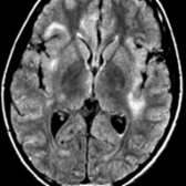 Axial FLAIR MR shows typical findings of ADEM with peripheral, subcortical hyperintense foci . Bilateral insular involvement is seen . Periventricular and callososeptal lesions, which are typical of multiple sclerosis, are not commonly seen in ADEM.