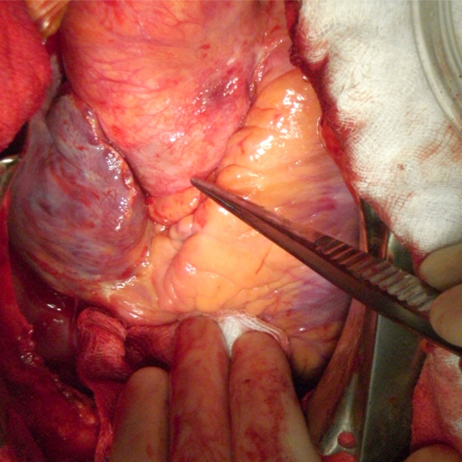 Corresponding intraoperative photograph shows a very thin aortic wall only consisting of residual adventitia. The normal aortic wall is thicker with a more yellow hue due to the underlying intact media, which contains elastin.