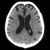 Axial CT in the same patient shows significant areas of brain atrophy   in the parietal lobe.