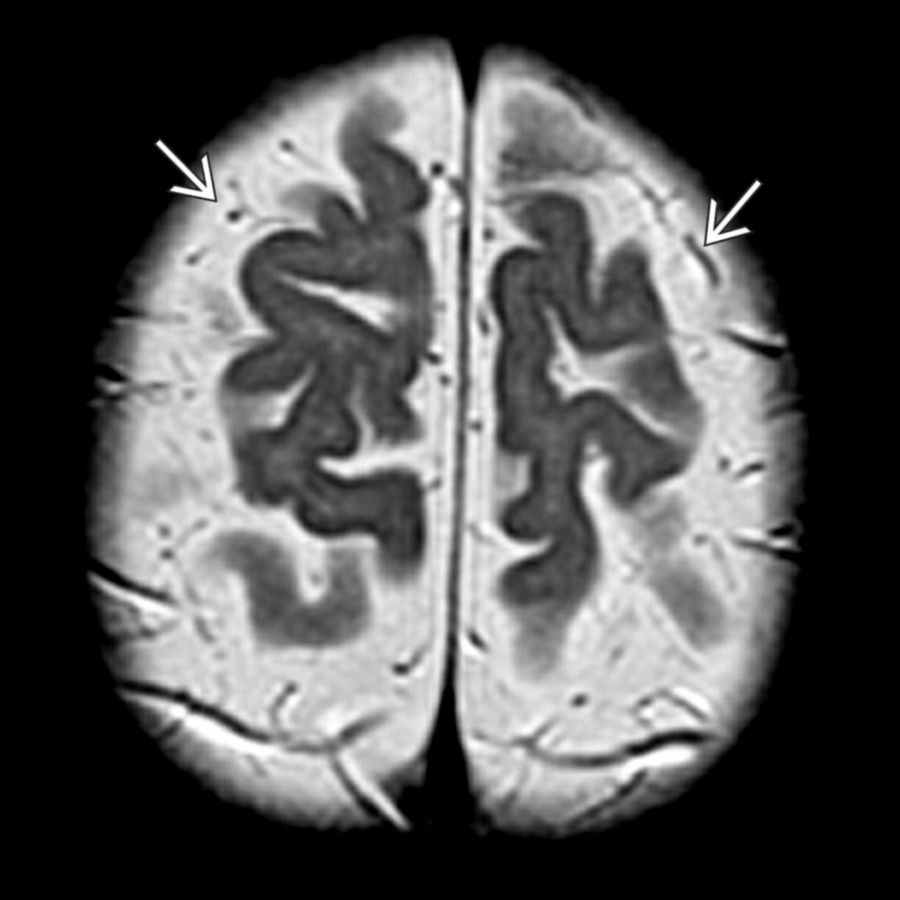 Axial T2 MR shows veins, represented by linear flow voids , traversing the enlarged SAS.