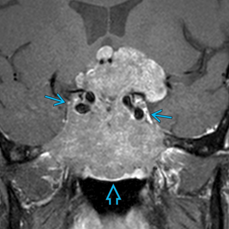 Coronal T1 C+ FS MR in the same patient shows a heterogeneous, hypoenhancing mass that invades the skull base  and encases the bilateral internal carotid artery (ICA) without luminal narrowing  in this case of invasive pituitary macroadenoma.