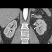 More anterior coronal CT shows the adrenal glands and their relation to adjacent structures, such as the crura of the diaphragm.