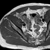 Axial T1 MR at a lower level shows the iliopsoas as 1 muscle bundle.