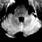 Axial DWI MR of a 58-year-old man with rapidly progressive dementia, myoclonus, and ataxia due to sCJD demonstrates diffusion restriction involving the left cerebellum .
