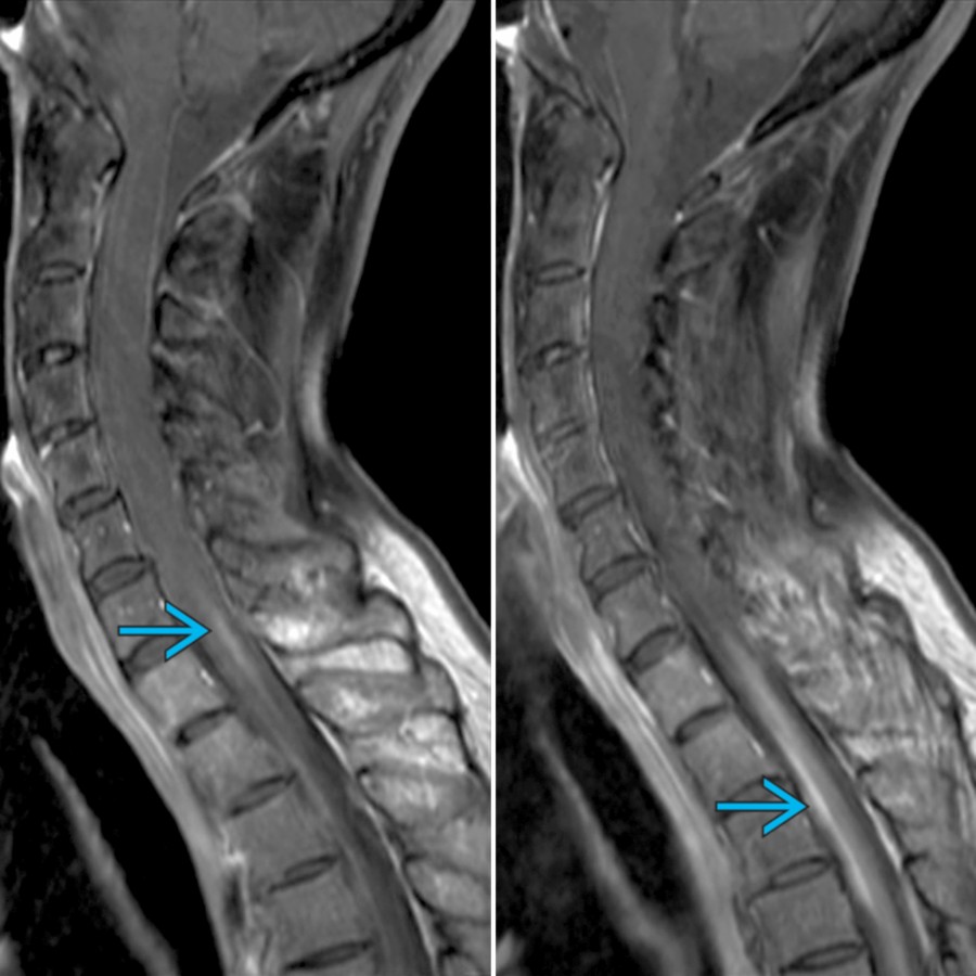 Sagittal T1 C+ FS MR in the same patient demonstrates patchy enhancement  in the cervical and upper thoracic cord. Cord lesions in NMOSD typically extend over 3 or more contiguous vertebral segments. There is involvement of the central gray matter or central and peripheral regions of the cord with > 50% cord area in the axial plane.